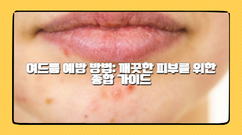 깨끗한 피부를 위한 여드름 예방 방법 알아보자